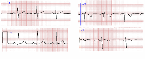 Зубец P в разных отведениях на ЭКГ.