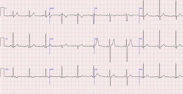 Пример нормальной ЭКГ.