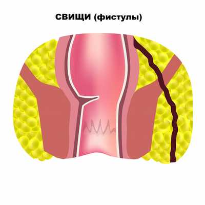 Фистула.jpg